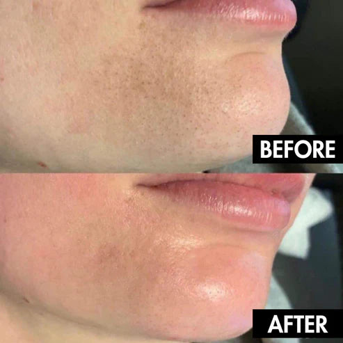 VacuaSkin™ Deep Pore Facial Vacuum